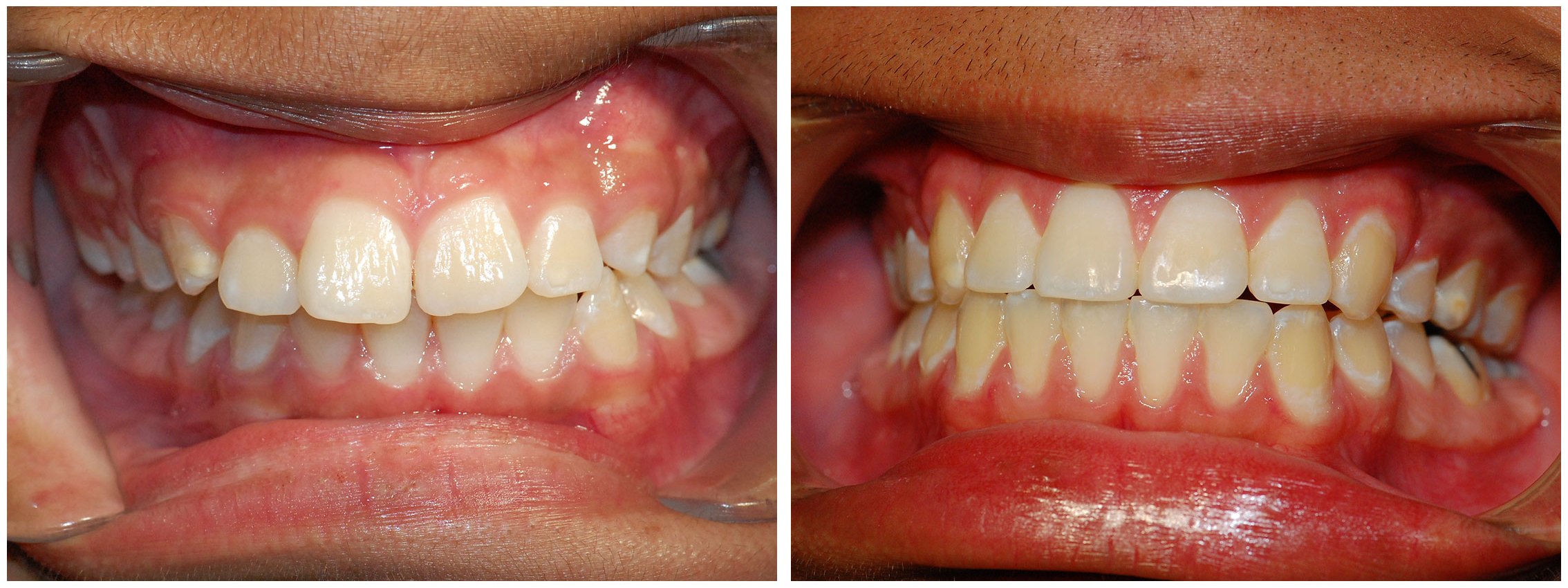 Childrens Dental Braces Treatment Before & After