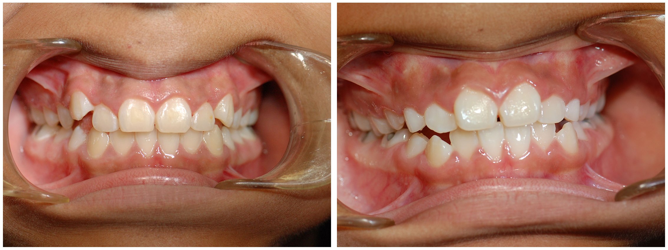 Childrens Dental Braces Before & After