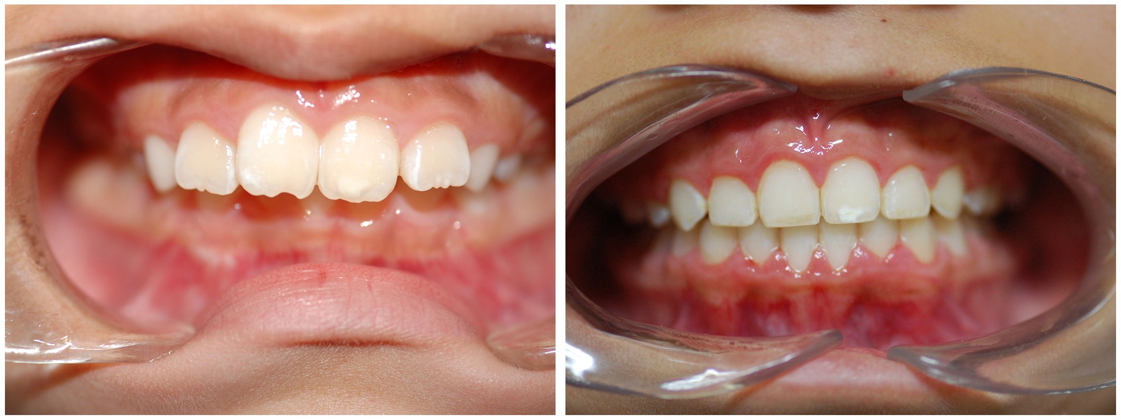 Childrens Dental Braces Before & After