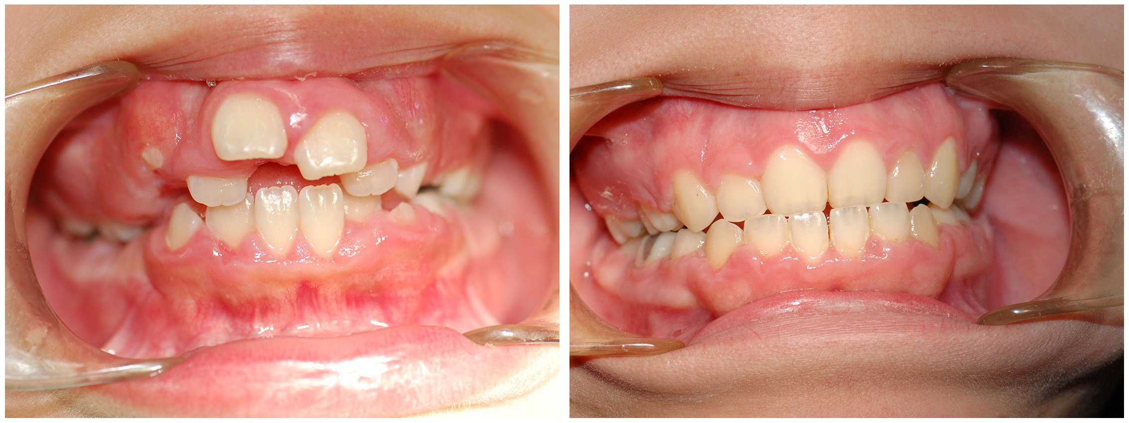 Infant Dental Braces Before & After