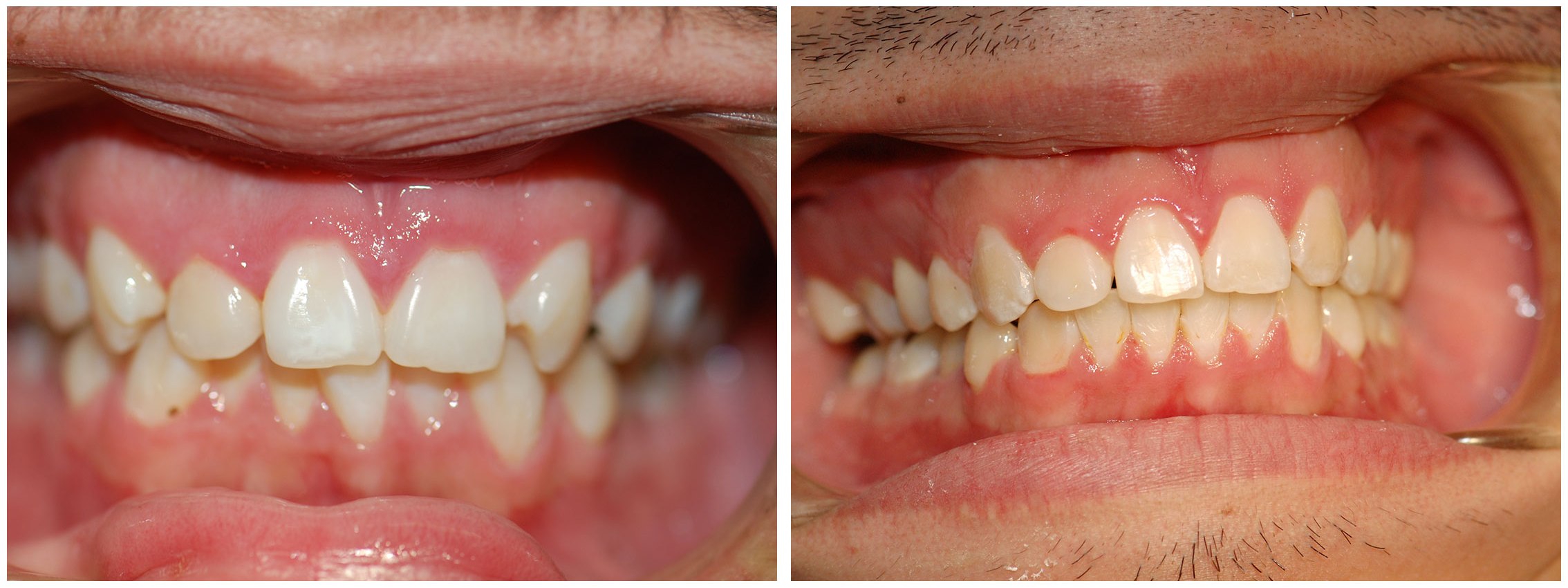 Kids Dental Braces Treatment Before & After