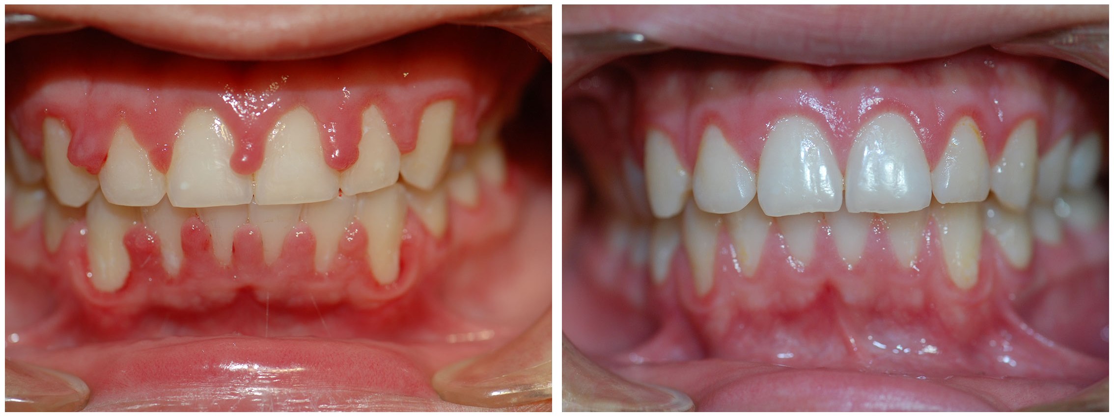 Kids Dental Braces Before & After