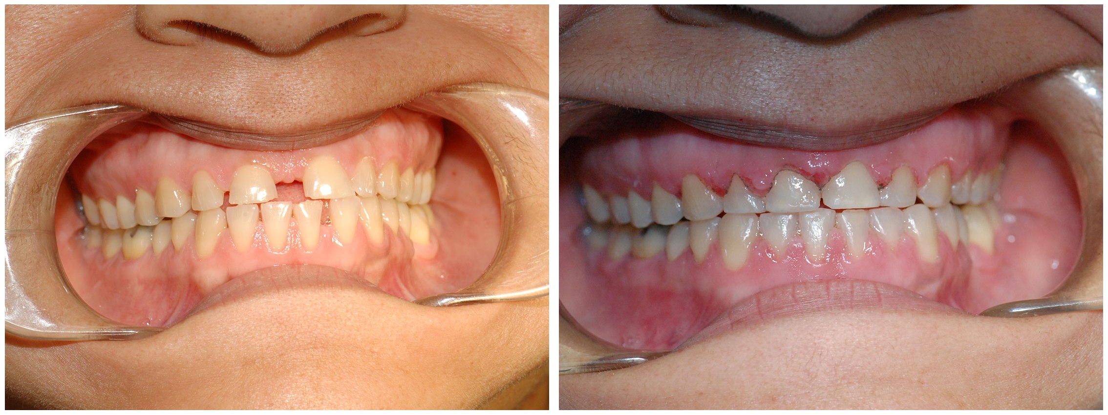 Orthodontic Dental Braces Before & After