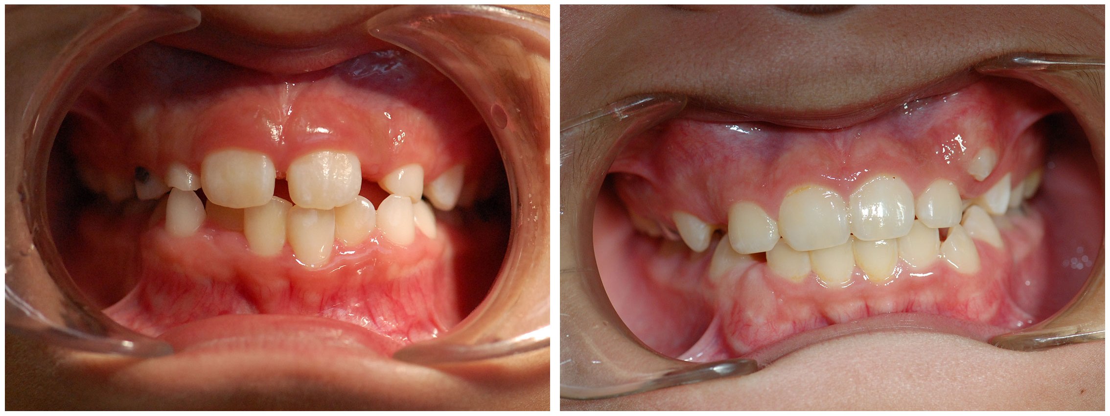 Orthodontic Dental Braces Before & After