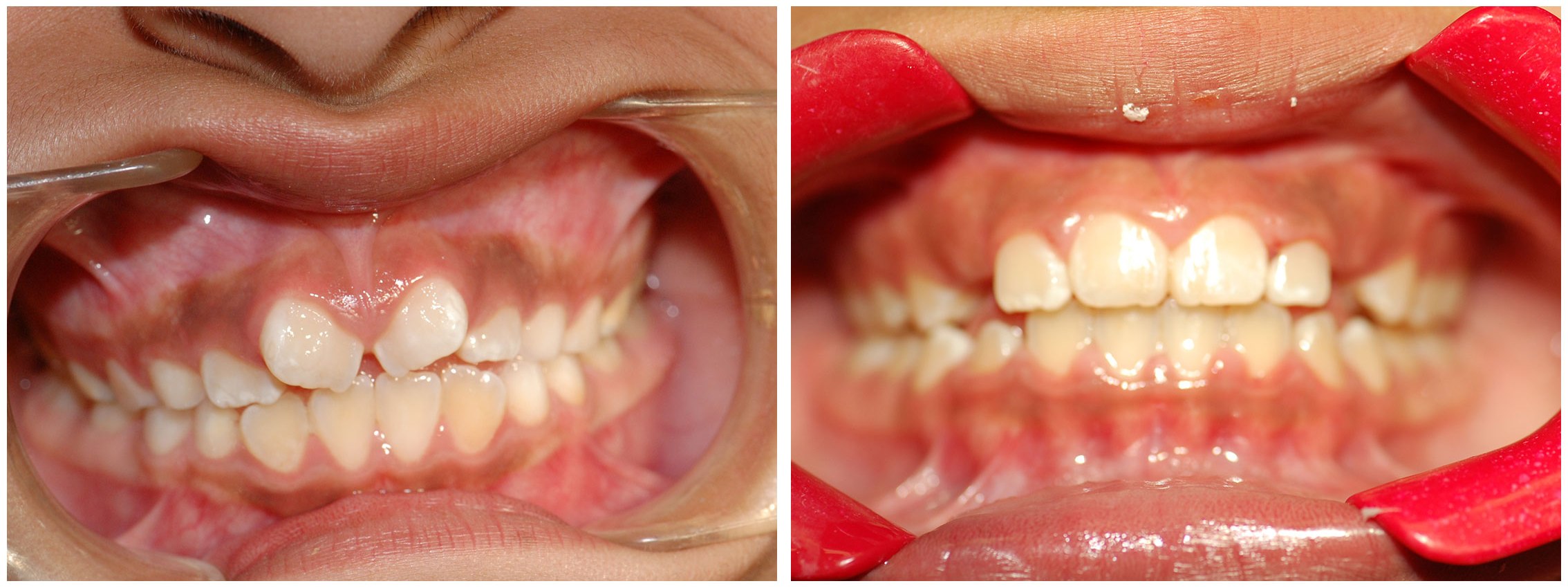 Orthodontist Dental Braces Treatment Before & After