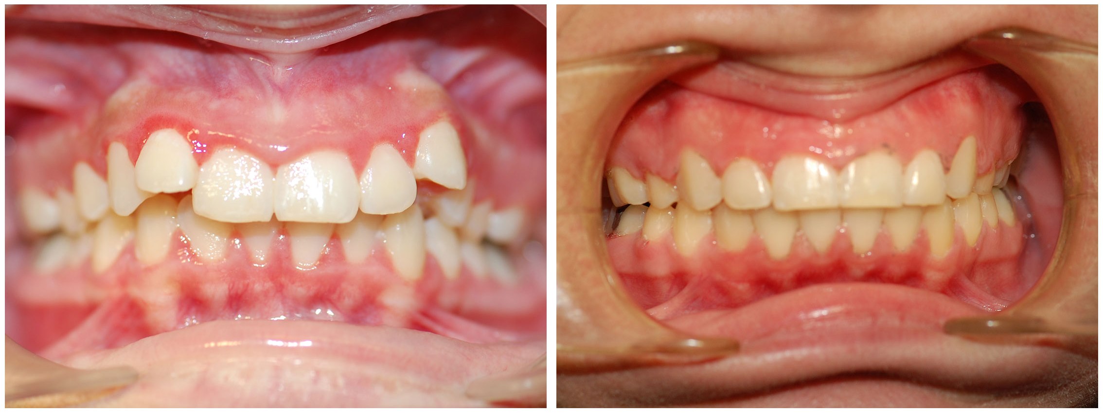 Orthodontist Dental Braces Before & After