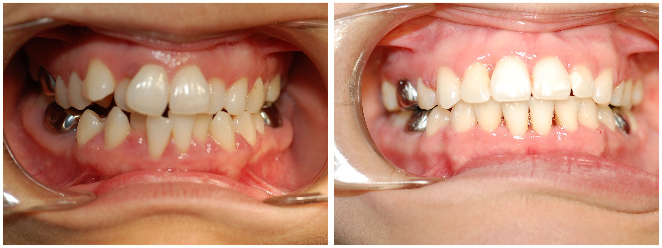 Orthodontist Dental Braces Before & After