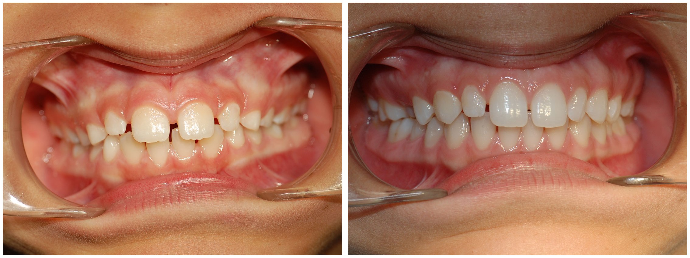 Pediatric Dental Braces Treatment Before & After