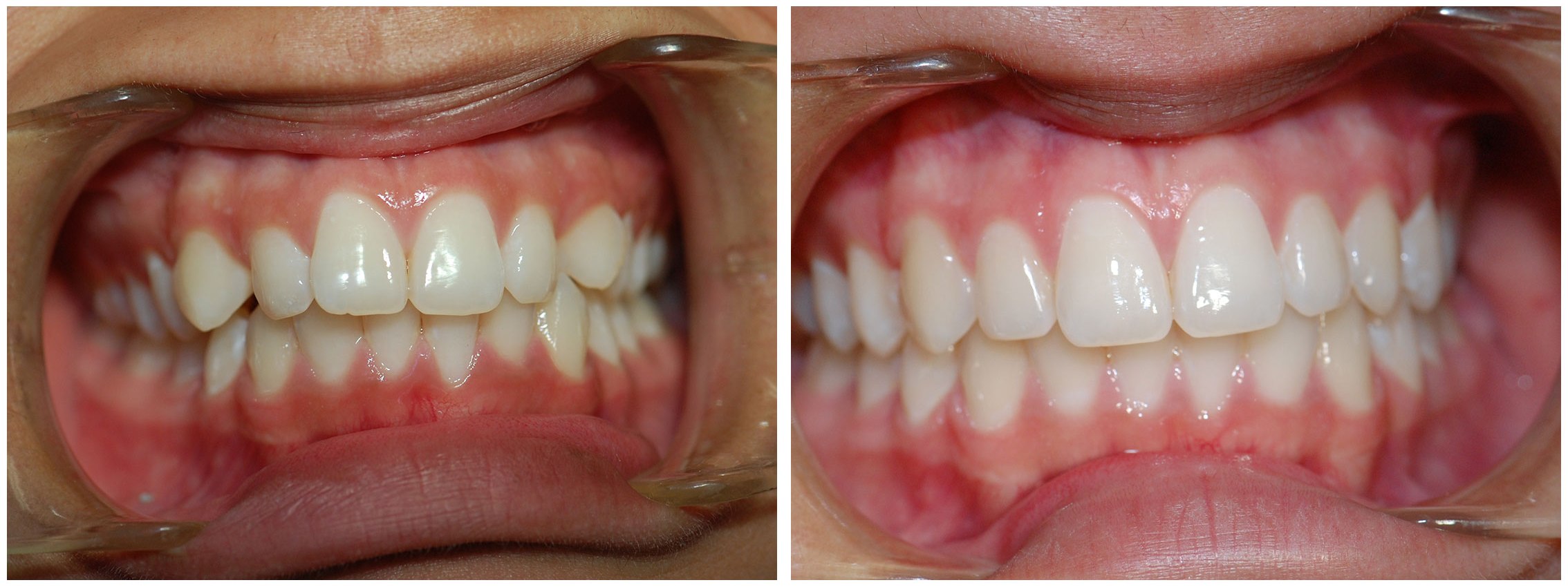 Pediatric Dental Braces Before & After