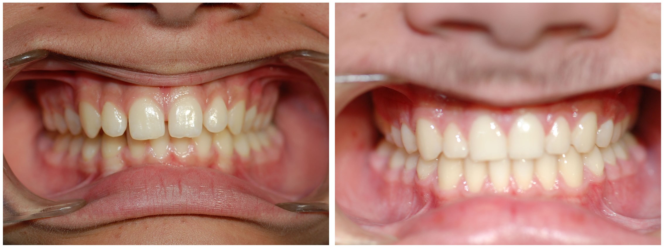 Pedodontist Dental Braces Treatment Before & After