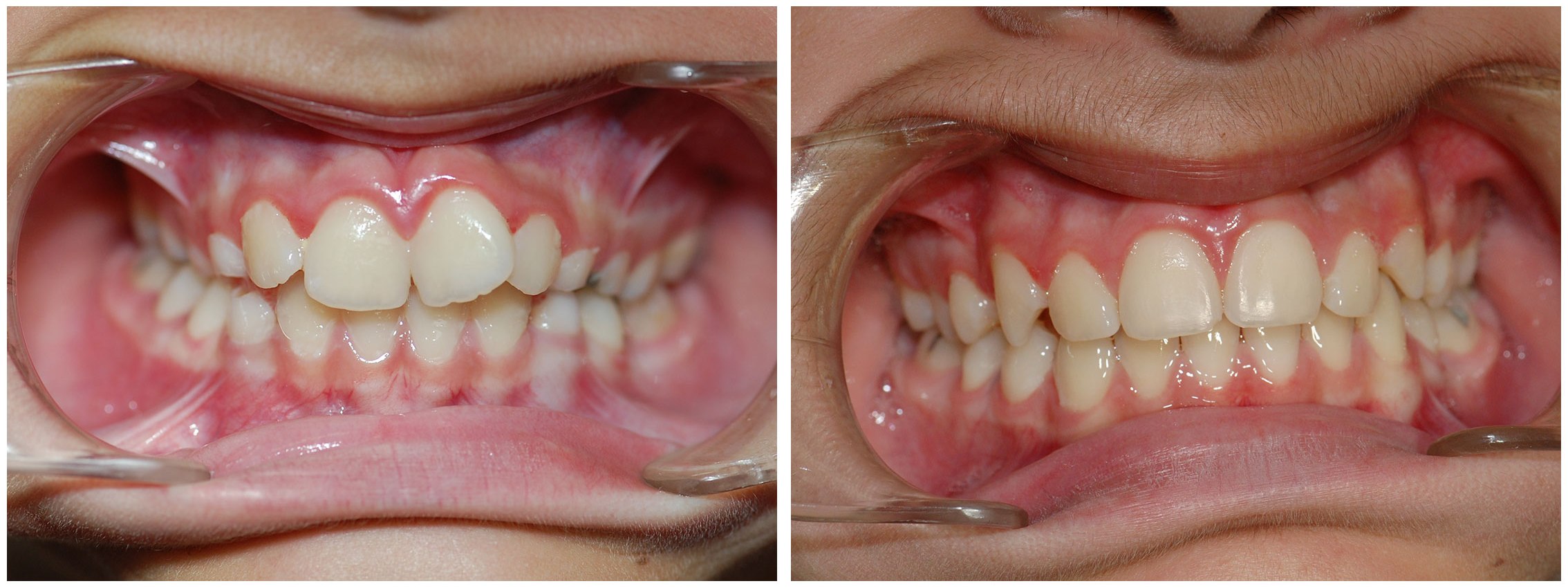 Pedodontist Dental Braces Before & After