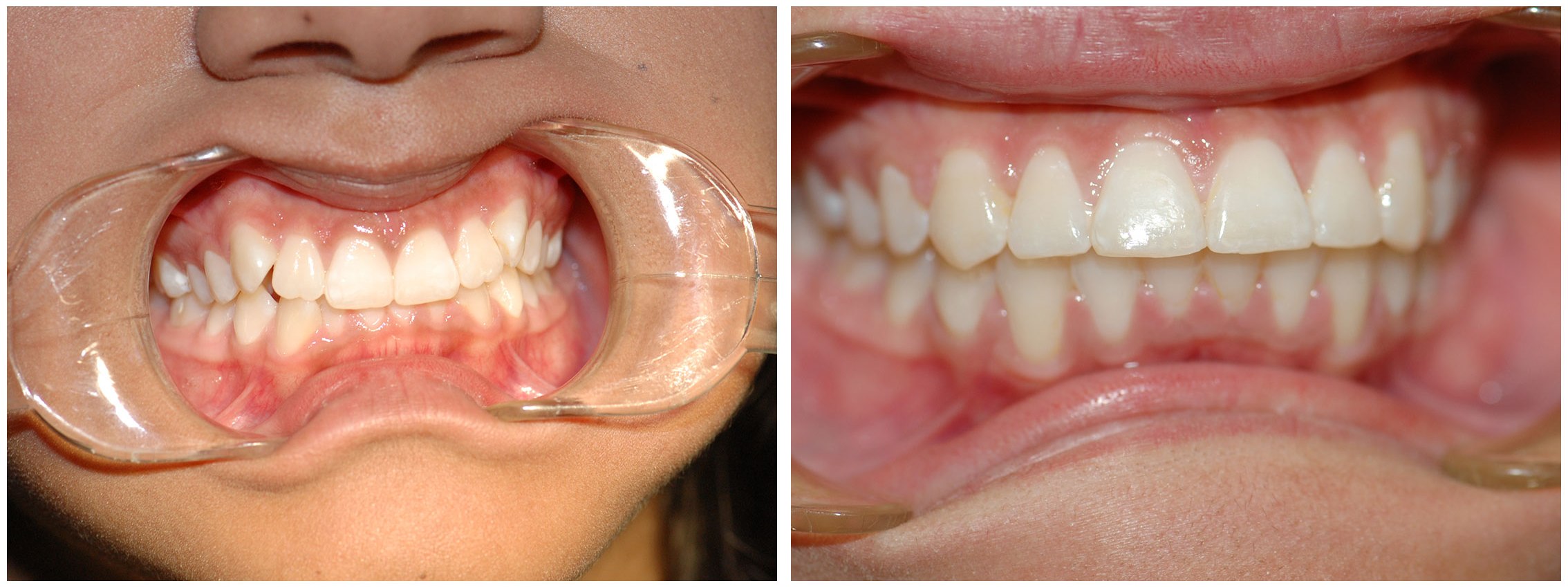 Periodontic Dental Braces Treatment Before & After