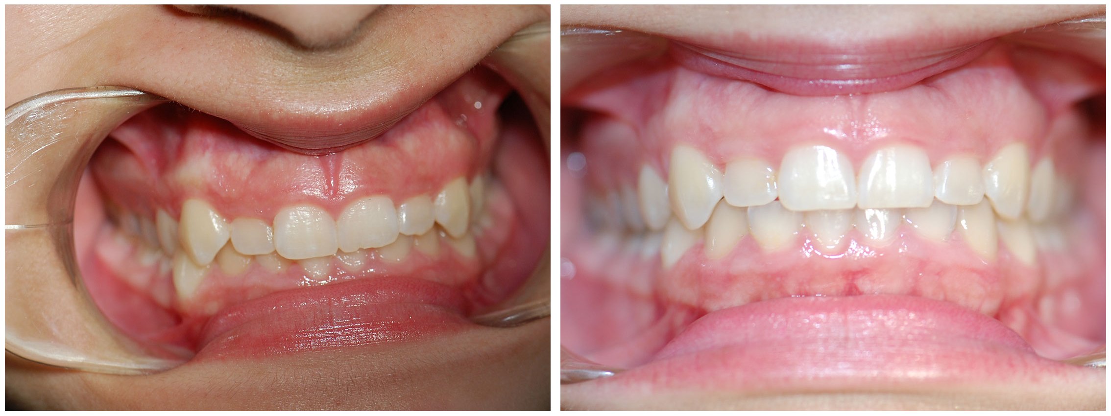 Periodontic Dental Braces Treatment Before & After