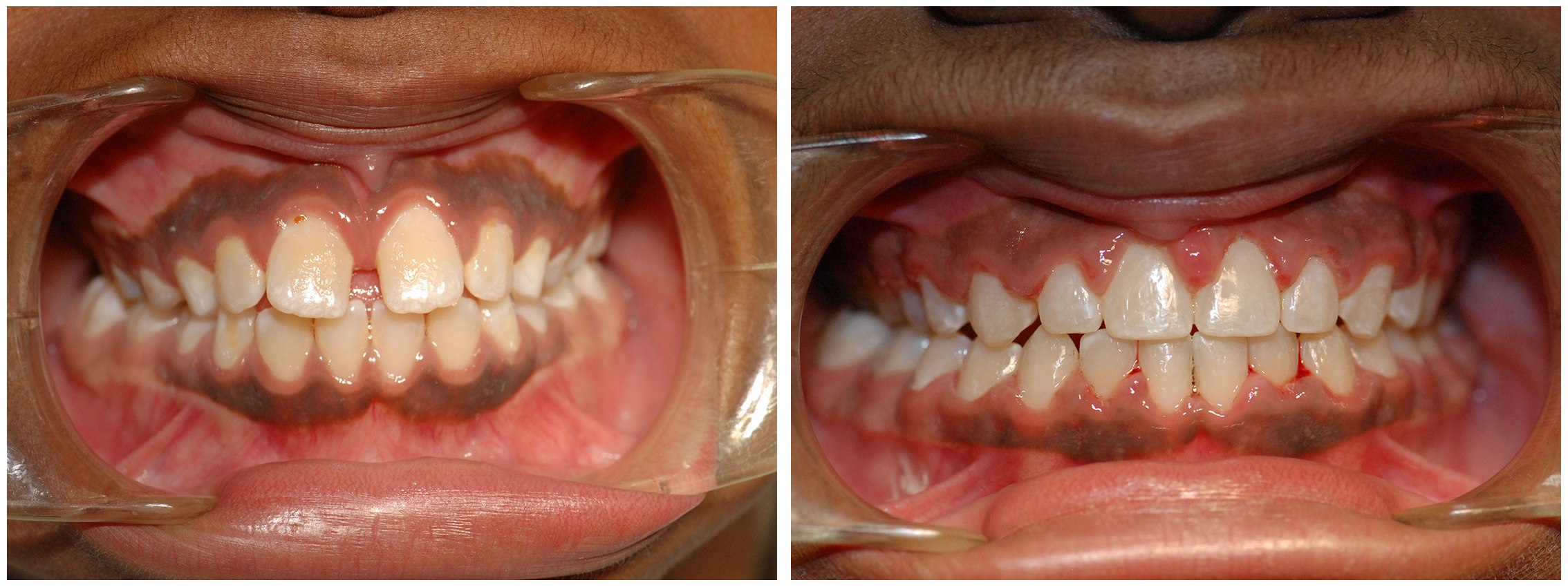 Periodontic Dental Braces Before & After