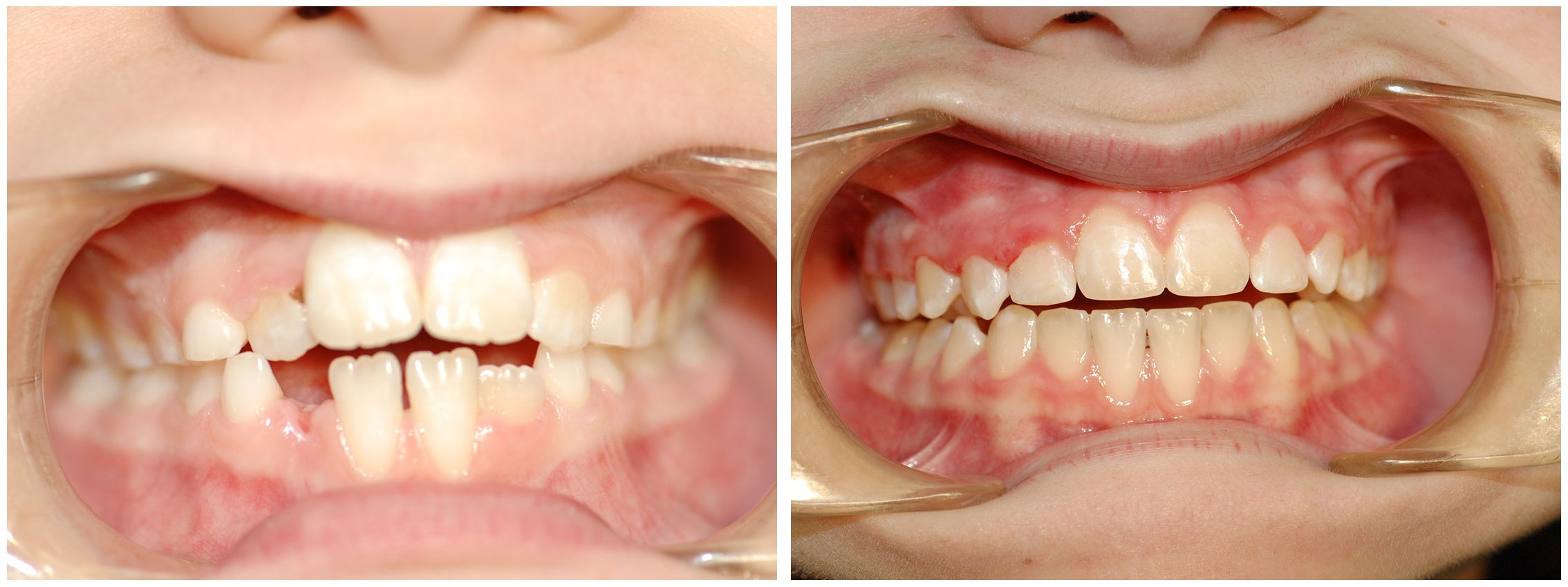 Periodontic Dental Braces Before & After