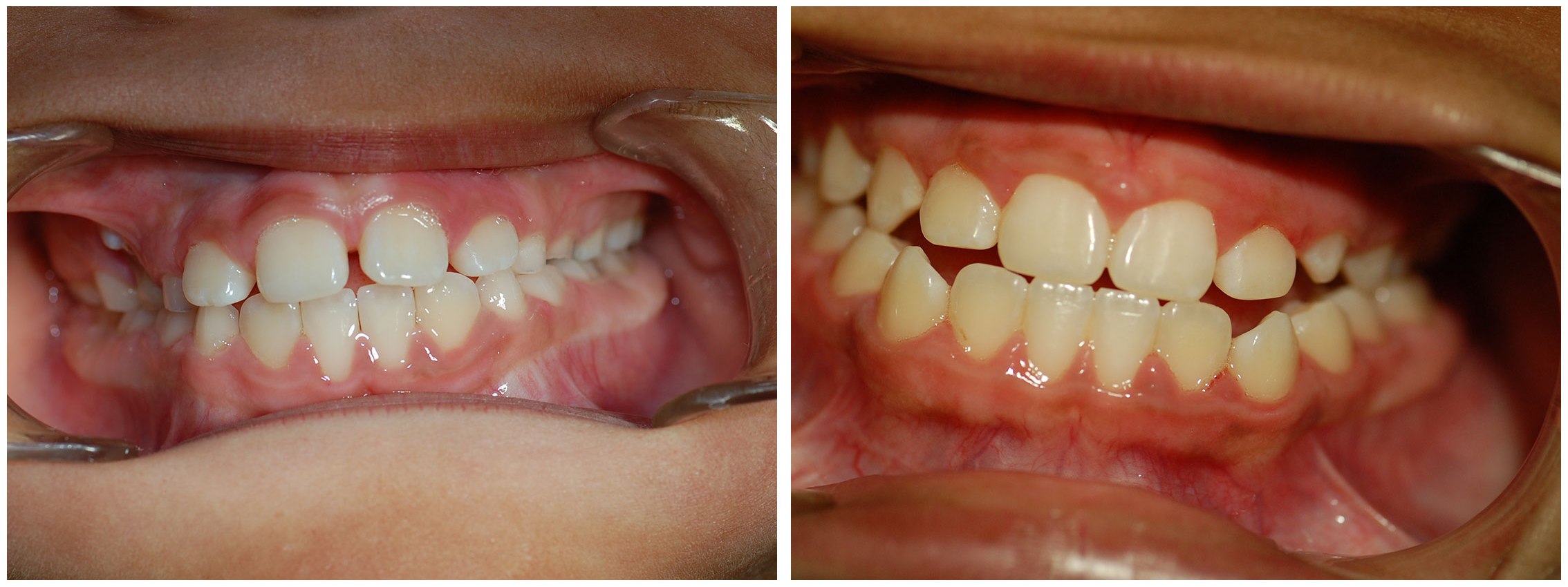 Periodontist Dental Braces Treatment Before & After