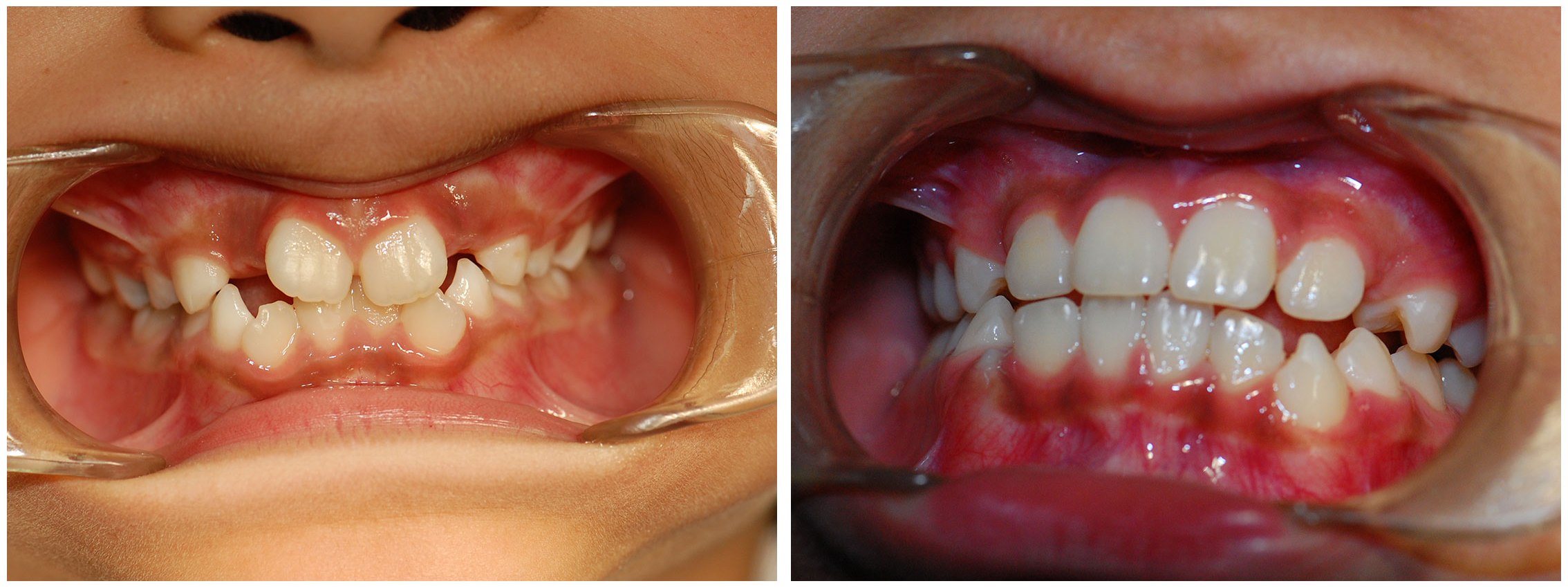 Periodontist Dental Braces Before & After