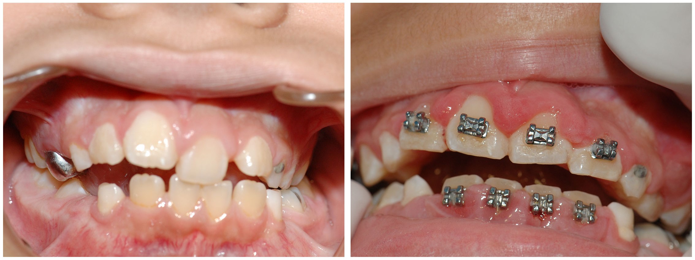 Periodontist Dental Braces Before & After