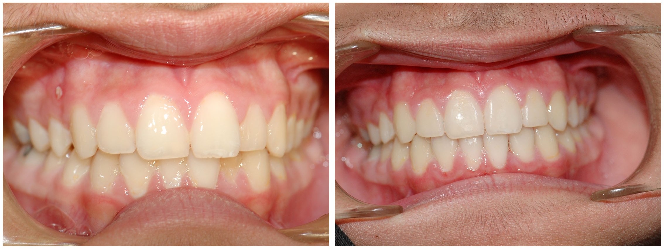 Redwood City Dental Braces Treatment Before & After