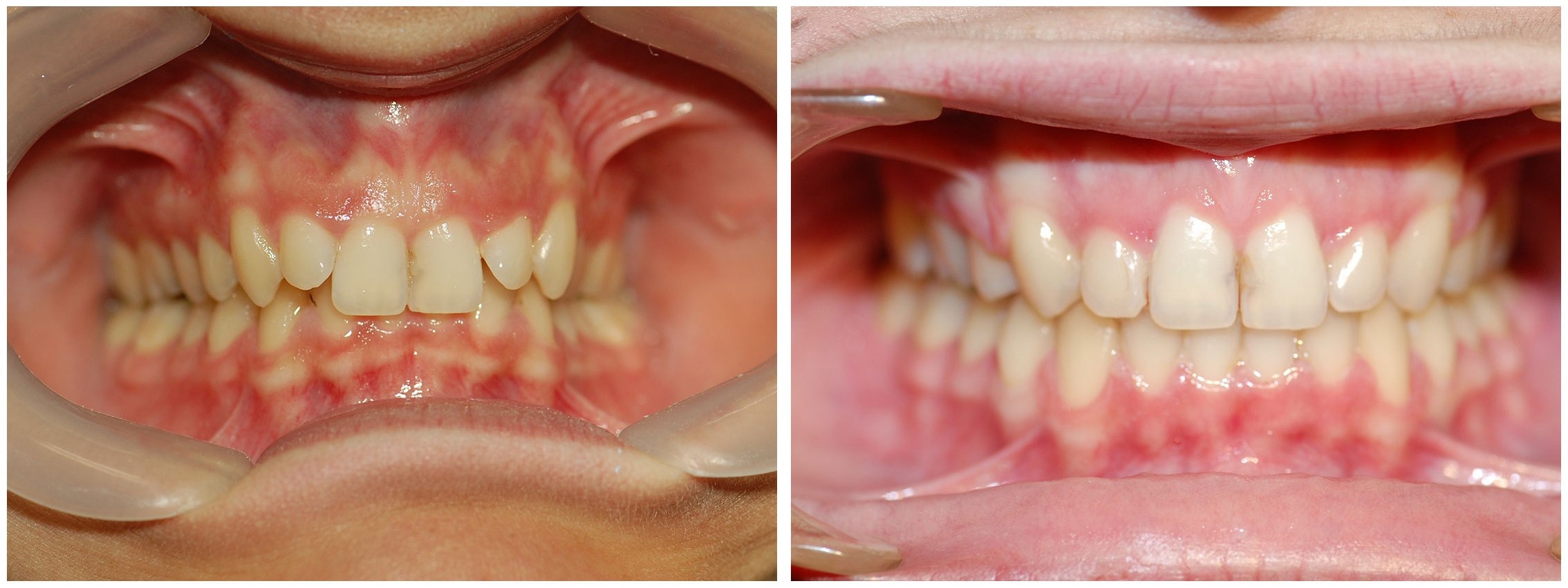 Teens Dental Braces Before & After