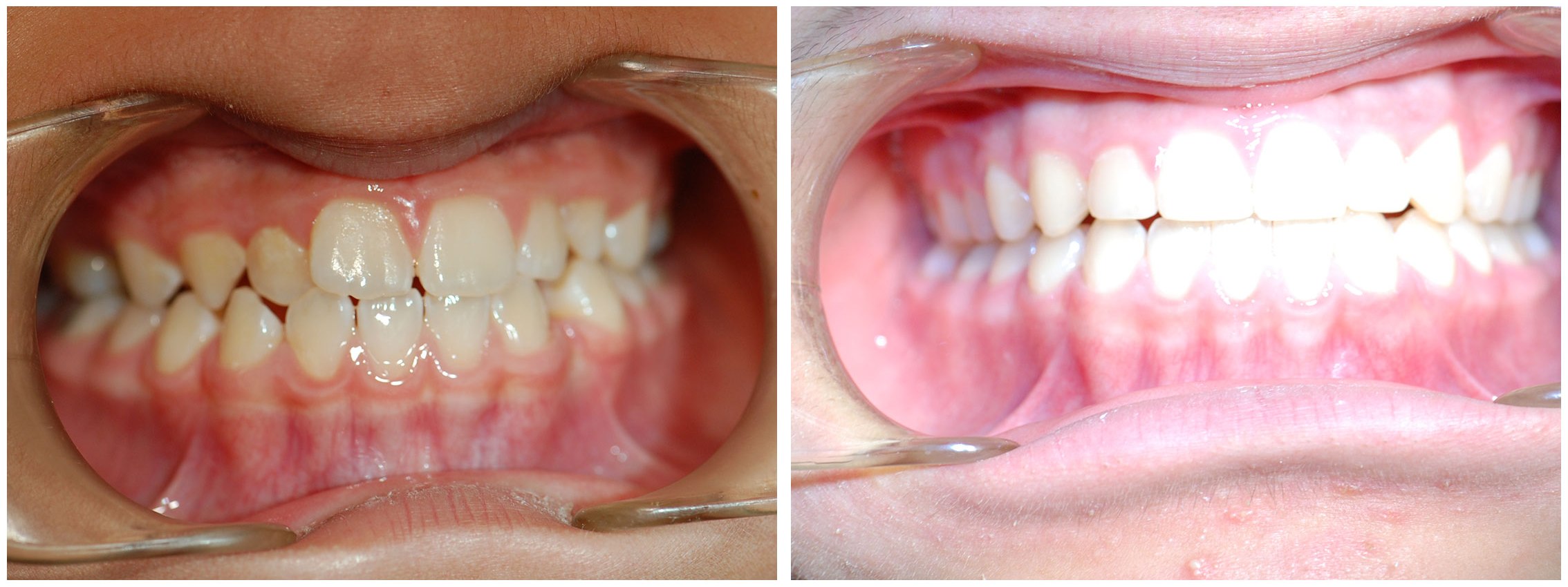 Teens Dental Braces Before & After
