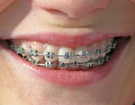 Metal Braces