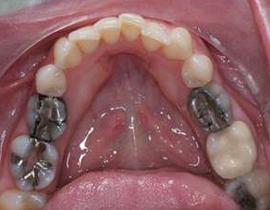 Metal Free Tooth Fillings