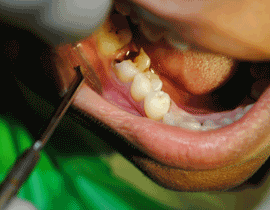 Dental Root Canal Treatment