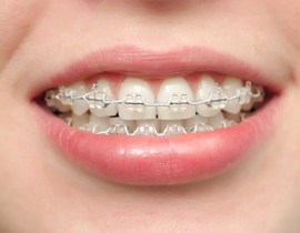 Teeth Clear Braces