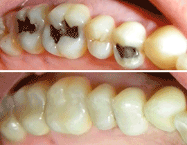 Dental Fillings